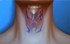 Larynx Transplant